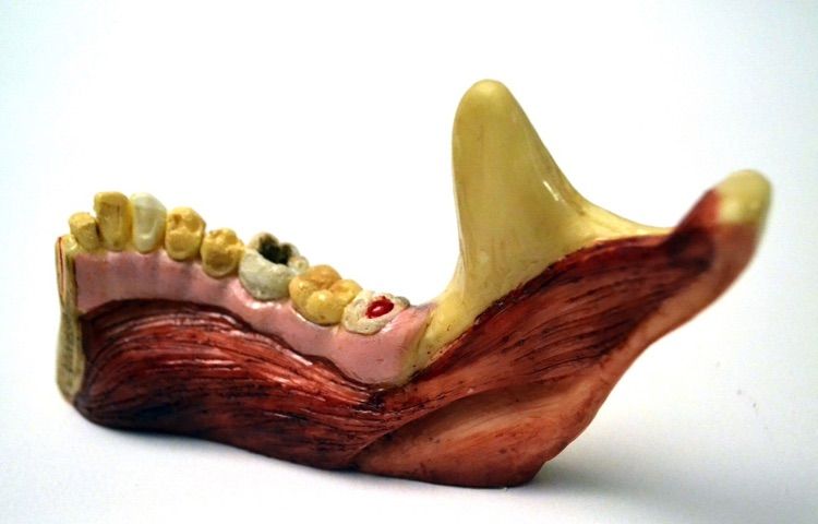 Аппетитные челюсти со следами серьезного заболевания десен