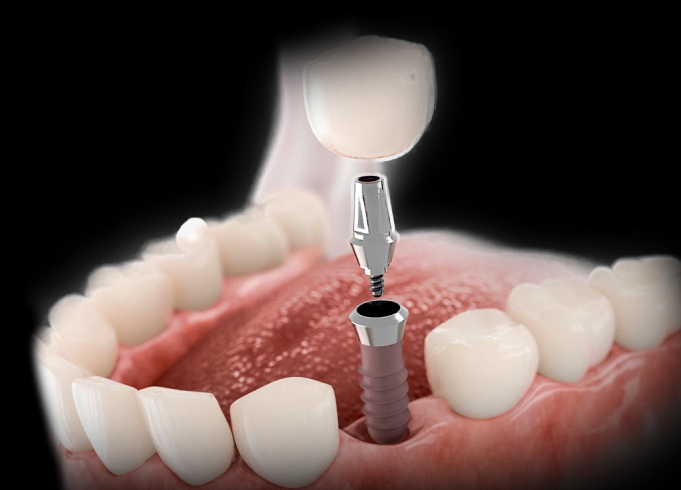 Как происходит установка импланта зуба: от теории к практике